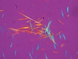 Varillas de cristales de urato monosódico fotografiadas bajo luz polarizada de una muestra de líquido sinovial. Formación de es: los cristales de ácido úrico monosódico en las articulaciones están asociados con la gota.
