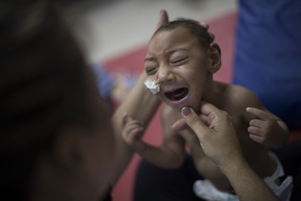 Las infecciones por Zika en mujeres embarazadas pueden hacer que sus hijos nazcan con defectos de nacimiento, incluyendo cabezas anormalmente pequeñas, como se ve en este niño brasileño. La propagación del Zika reavivó el debate sobre la conveniencia de volver a utilizar el DDT.